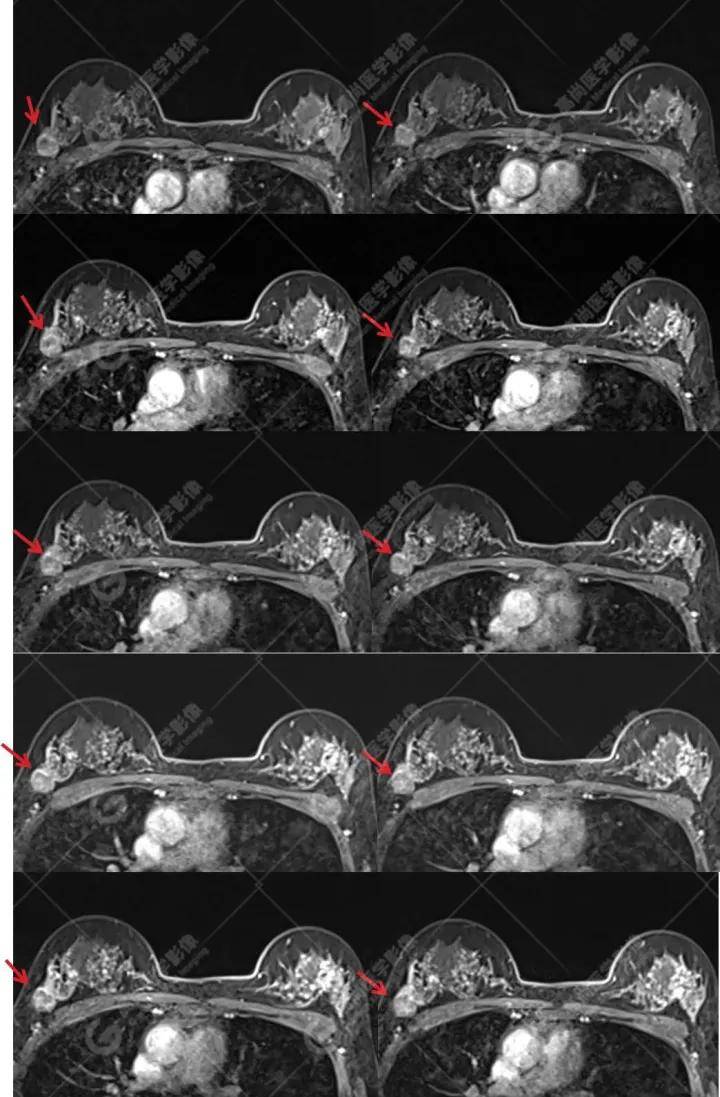 乳腺癌磁共振图片图片