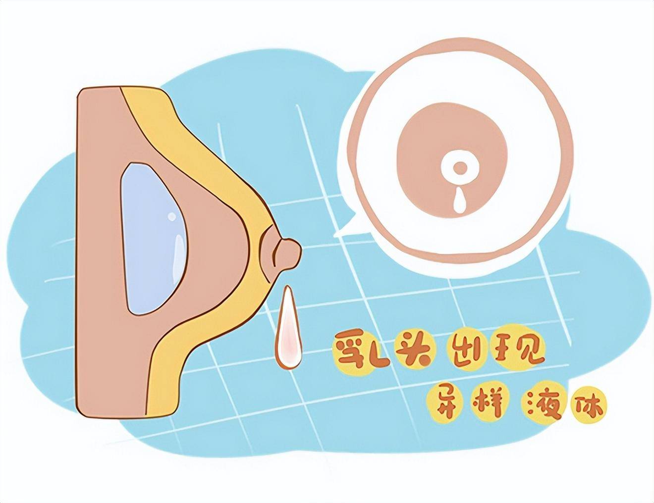 乳头溢液:非哺乳期的女性,突然出现乳头溢出不明分泌物,很可能是早期