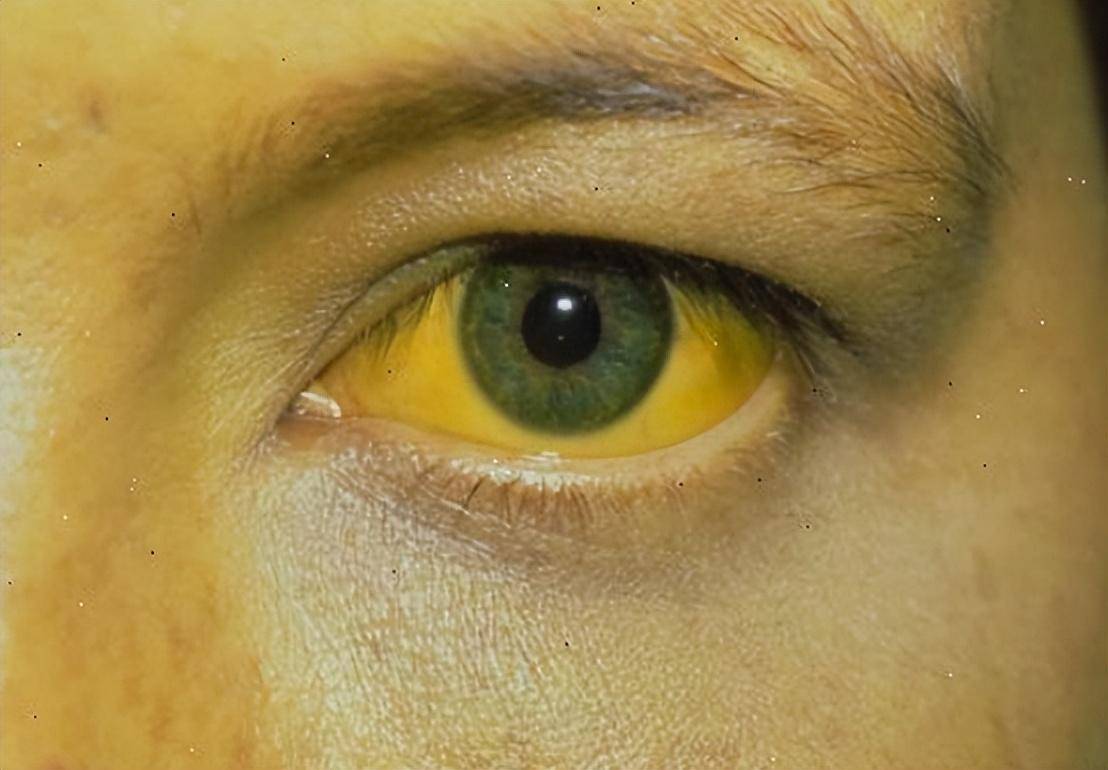 45岁男子每天大便两三次,确诊胰腺癌!