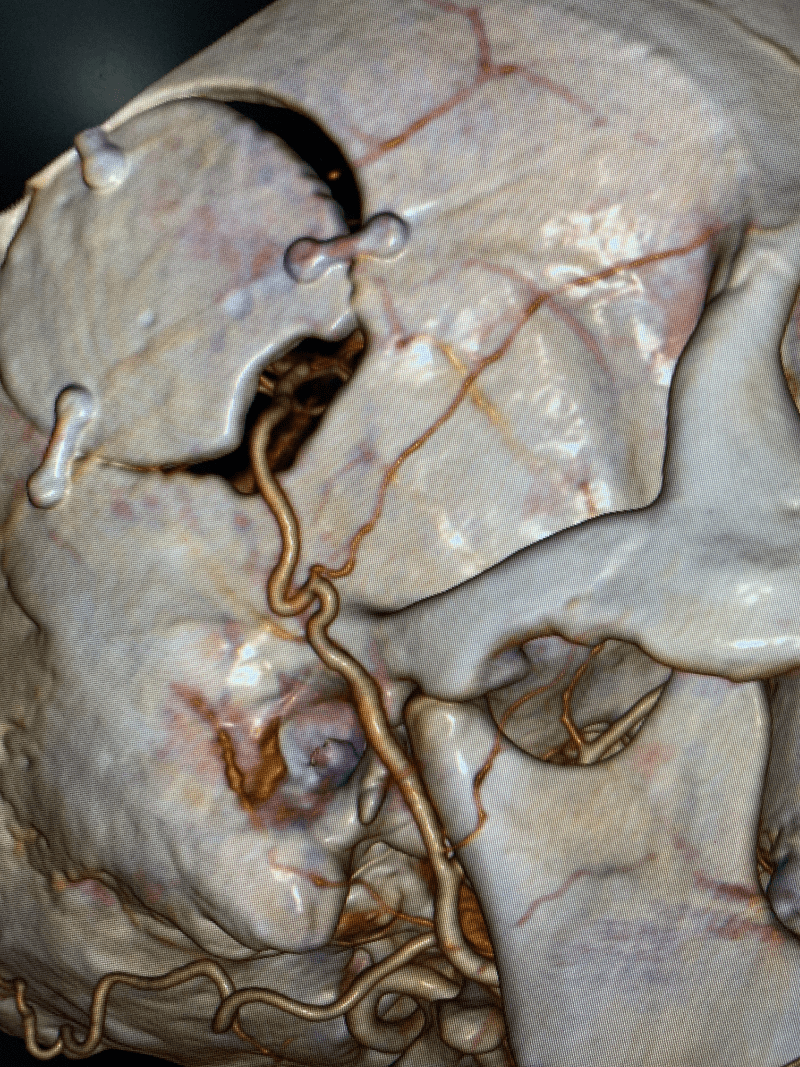 一毫米血管缝14针 - 脑血管搭桥 重建生命通道_患者_手术_治疗