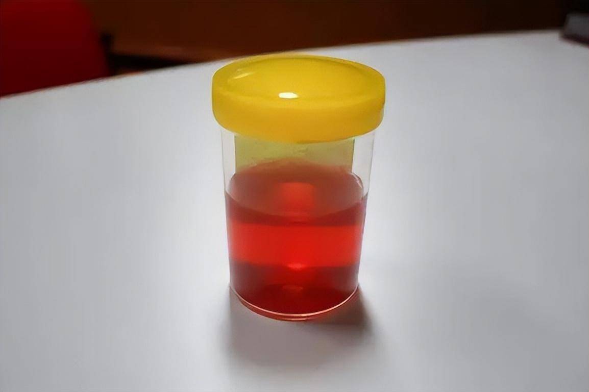但是,红色尿液也可能是疾病引起的,如血红蛋白尿,肾性血尿等,如果排除