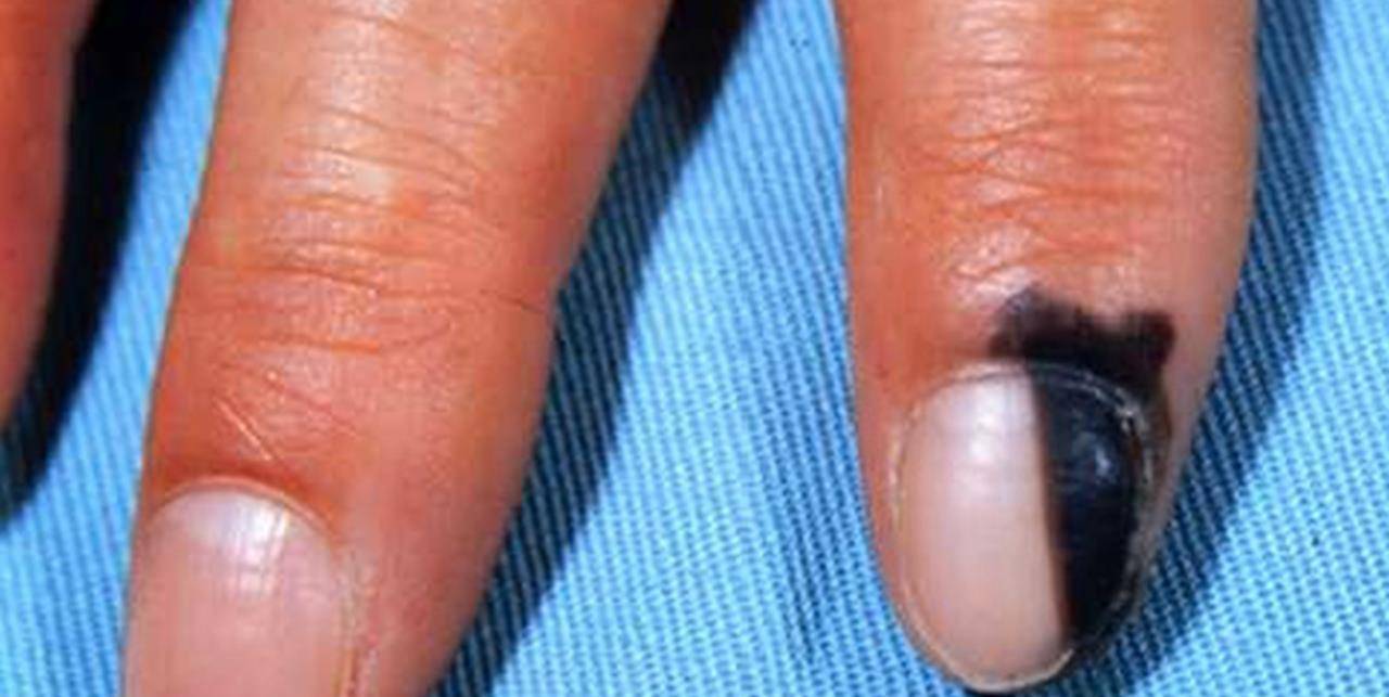 提醒:指甲若长成4种样子,可能是癌或疾病的信号,还请留心观察