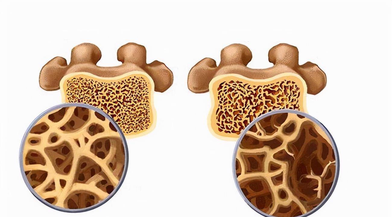 化合物羟基磷灰石ca10(po4)6(oh)2,就像混凝土一般,提升骨骼的硬度