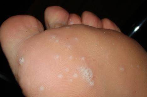 手脚总是长出很多小水泡,还很痒,是怎么回事?