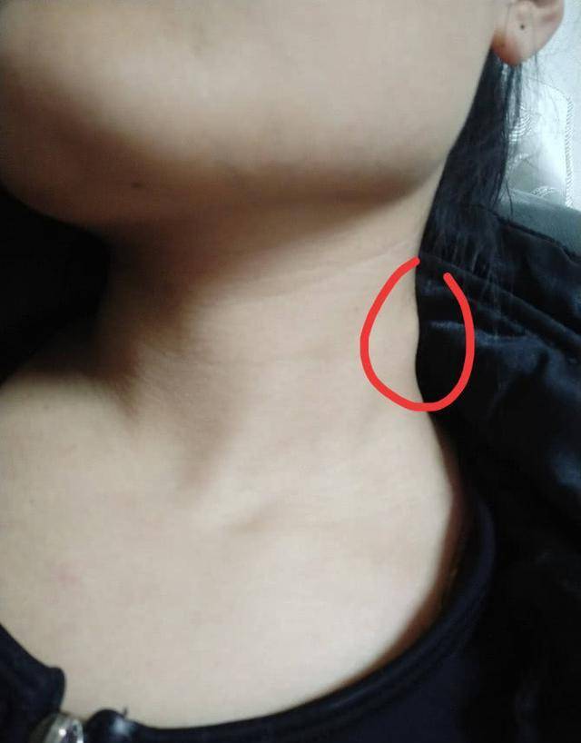 脖子上若出现3种现象,别忽视,可能跟病症有关,及时检查_身体_致病