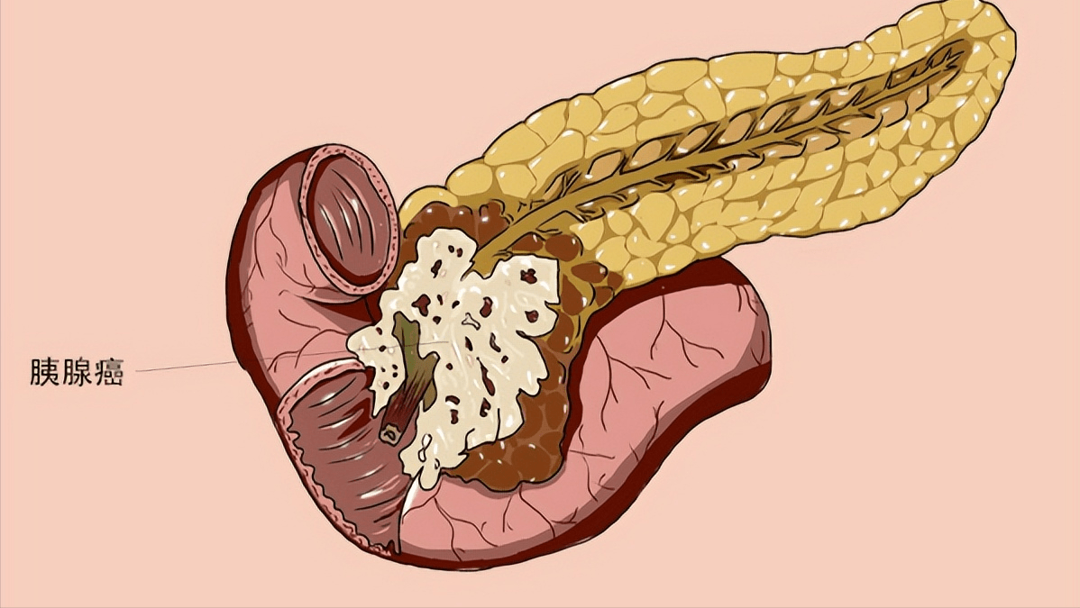 脂源性胰腺炎 来自搜狐网
