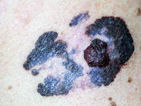 一些慢性刺激和炎症也会导致皮肤病,如慢性溃疡,盘状红斑狼疮,放射性