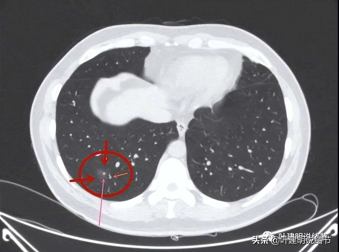 这样的混合磨玻璃结节别急着手术切除_病灶_密度_成分