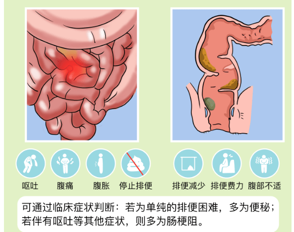 肠梗阻与便秘的区别