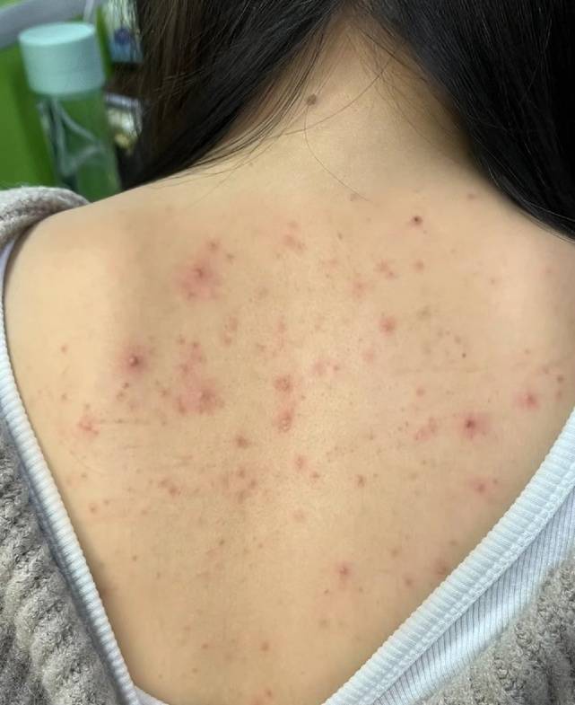 折磨我几年的出油冒痘终于好了!多亏这几种方法!看了不后悔系列!