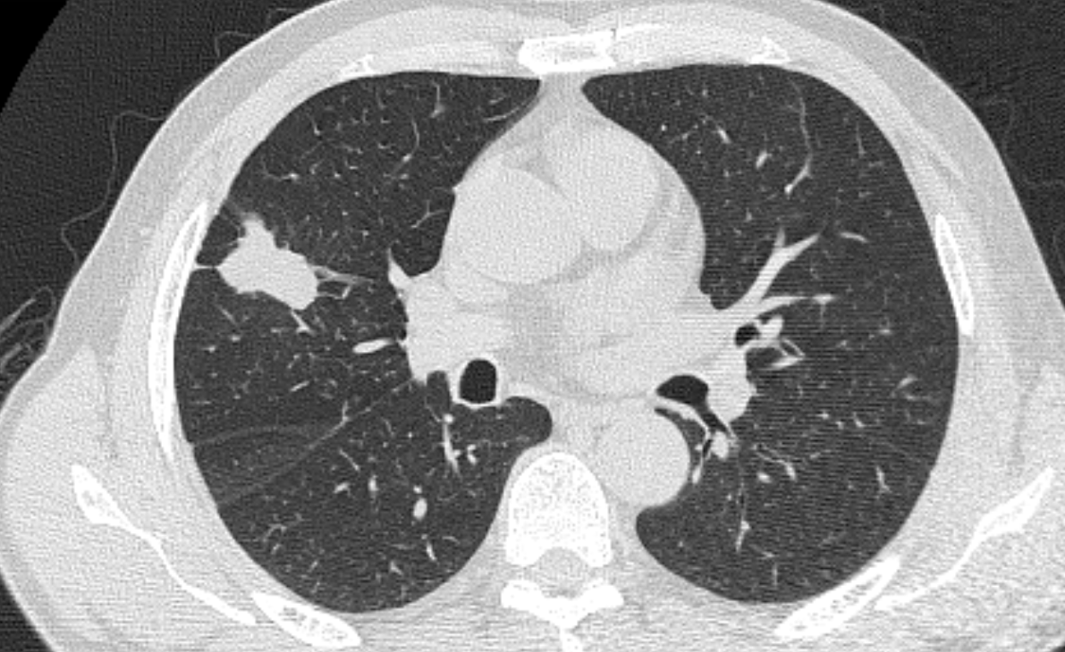 肺结节看诊36:只是在ct片中多看"你"一眼,"恶性"结节成良性_积液_病灶