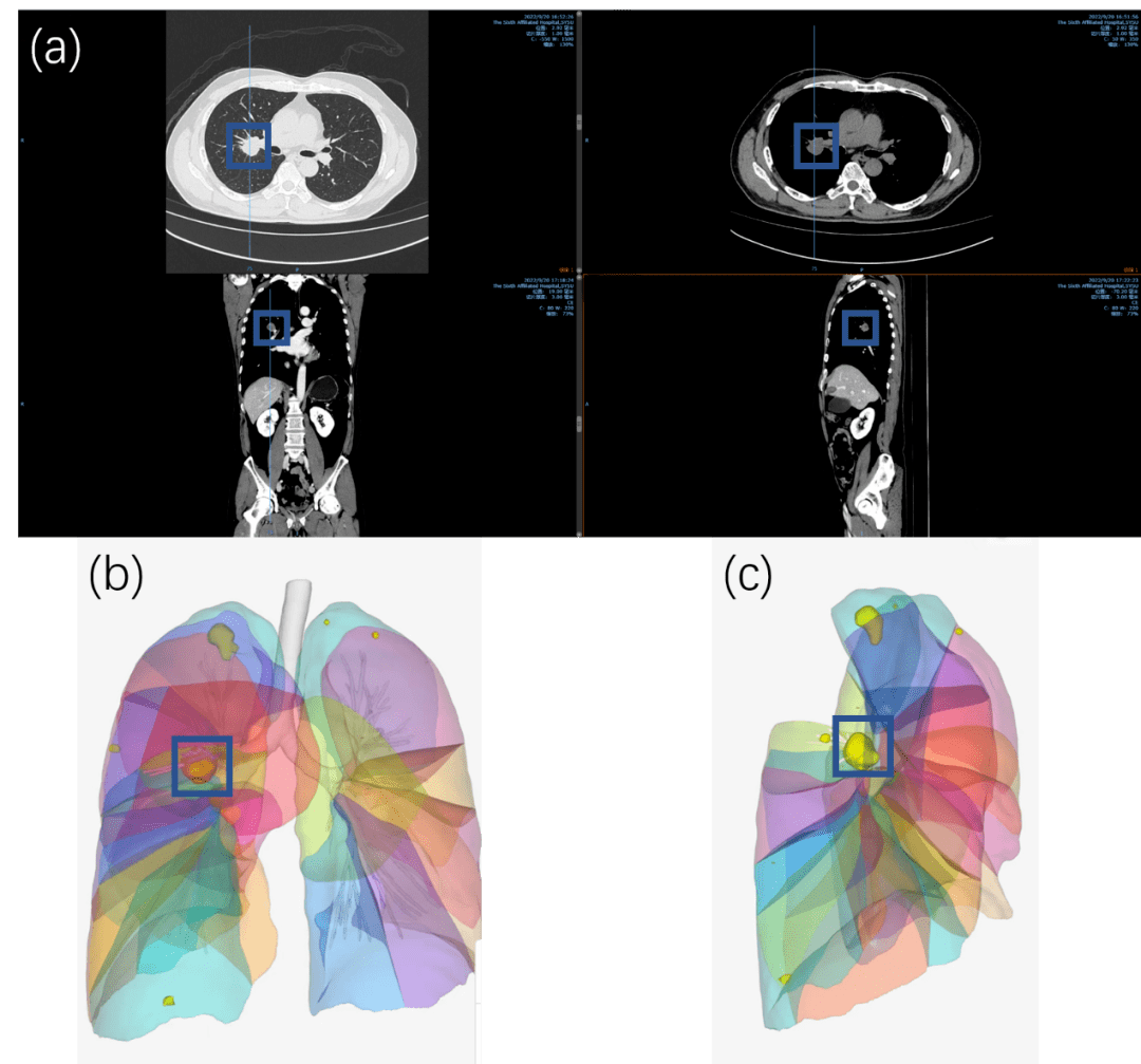 不規則的肺結節一定是肺癌嗎?pet ct=真相!_病變_玻璃_顯示