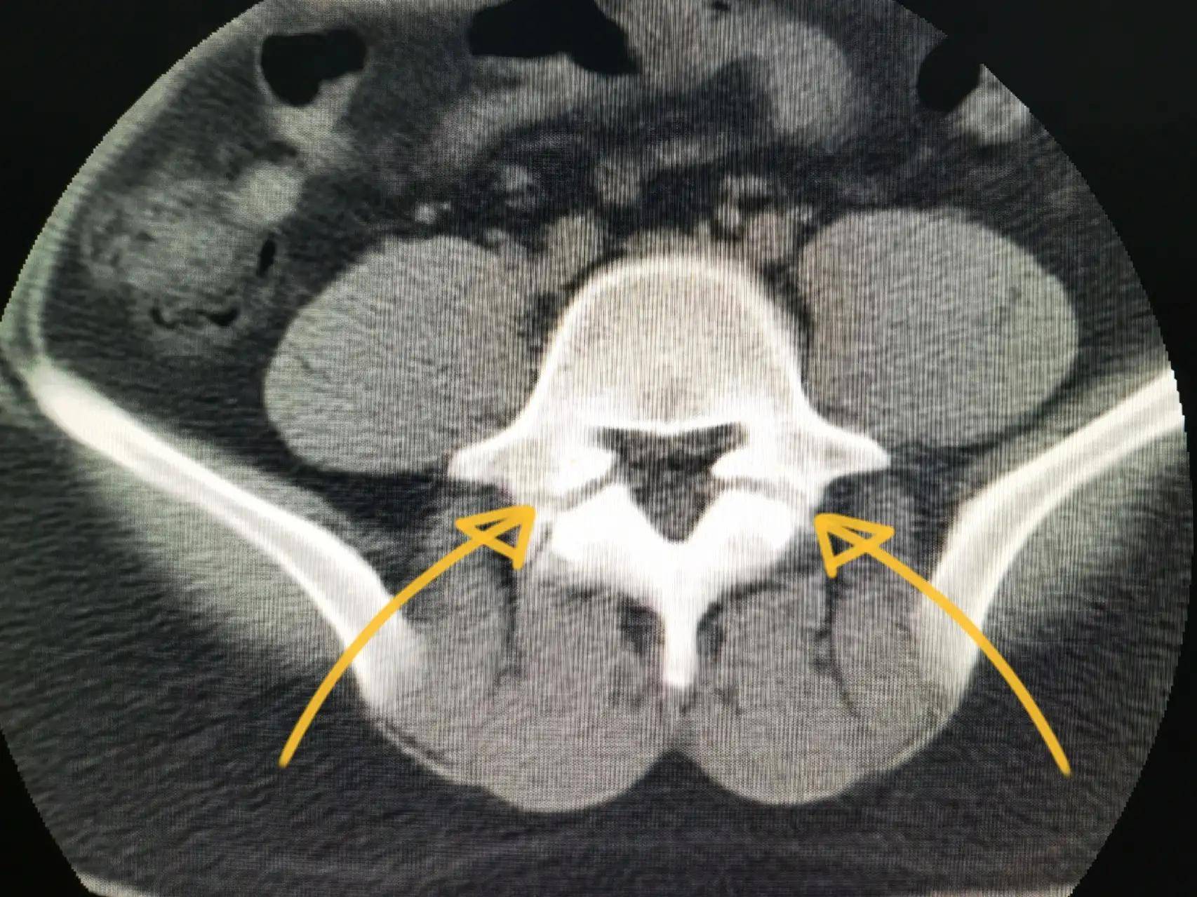 腰椎椎弓峡部裂图片图片