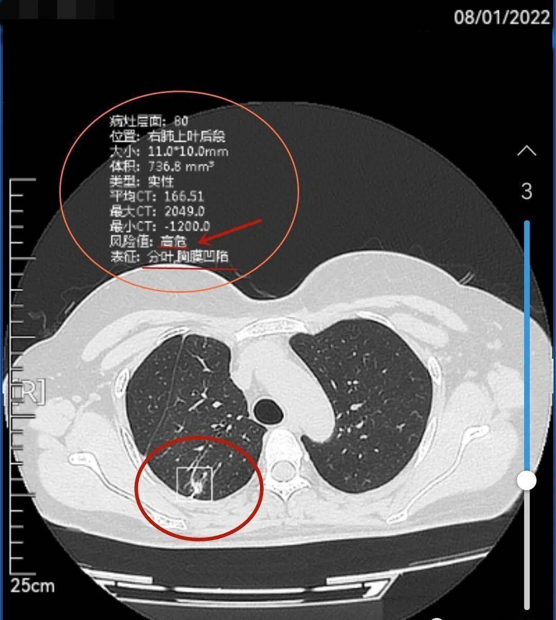肺结节诊断报告图片图片