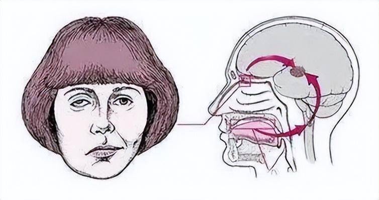 五,面部肌肉萎缩到后期会严重地影响患者的视力以及咀嚼能力