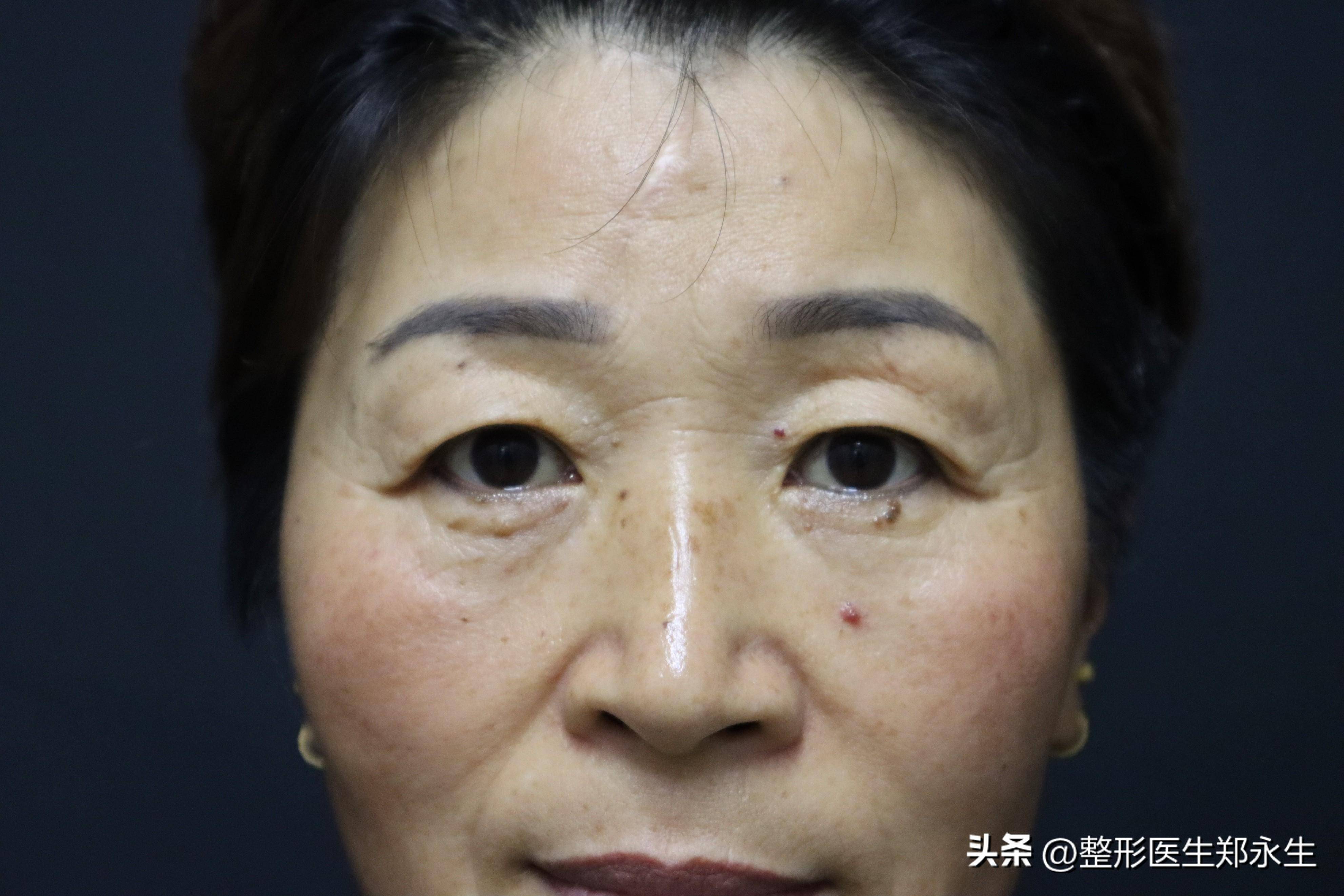 人眼皮尤其是眼尾都耷拉下来了,年轻时候漂亮的眼睛逐渐变成了三角眼