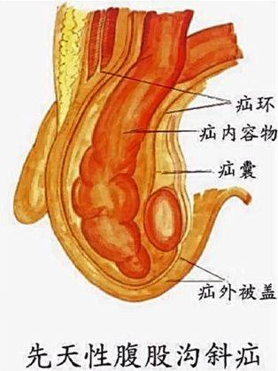 疝环口图片