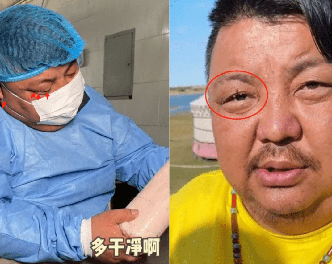 这个黑斑之前在网红泡泡龙上也有,被称为黑棘皮,很多肥胖患者身上都会