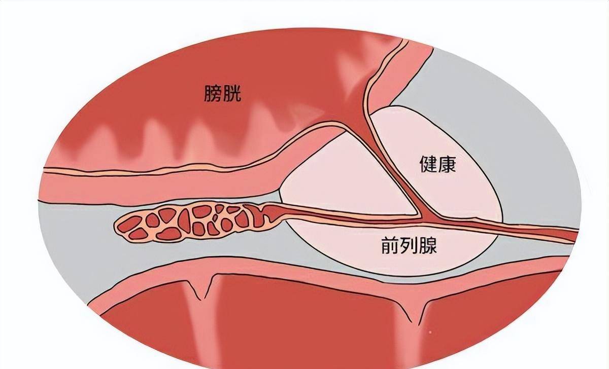 醫生坦言:男人有這4個習慣,前列腺別想好_膀胱_尿液_男性