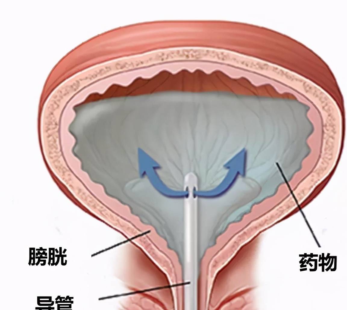 膀胱原位癌 "渣癌"分手记_灌注_治疗_恶性肿瘤