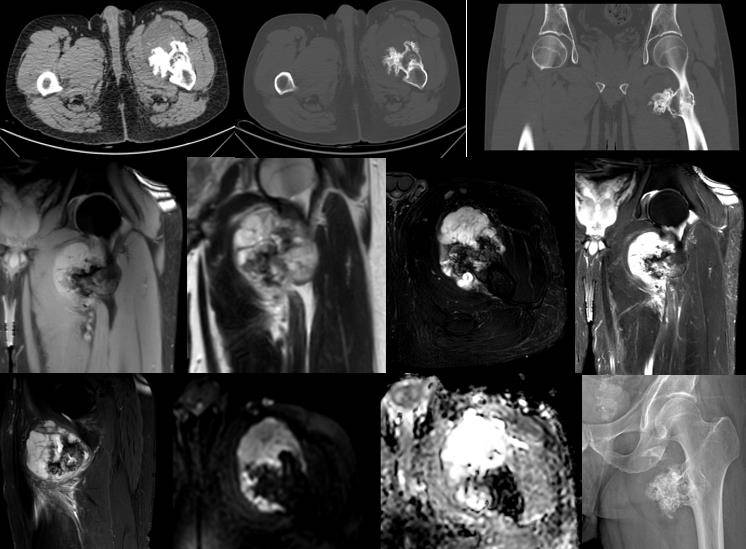 軟骨肉瘤ct mri 2023.3.9_信號_鈣化_腹股溝