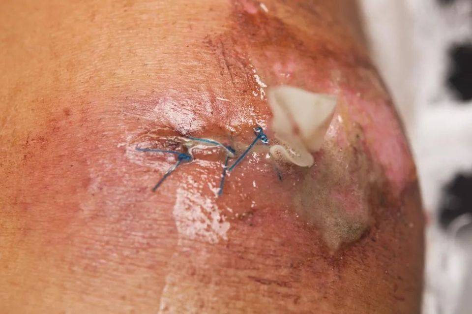 组织液为什么会渗出到淋巴中为什么在线 组织液为什么会渗出到淋巴中为什么在线