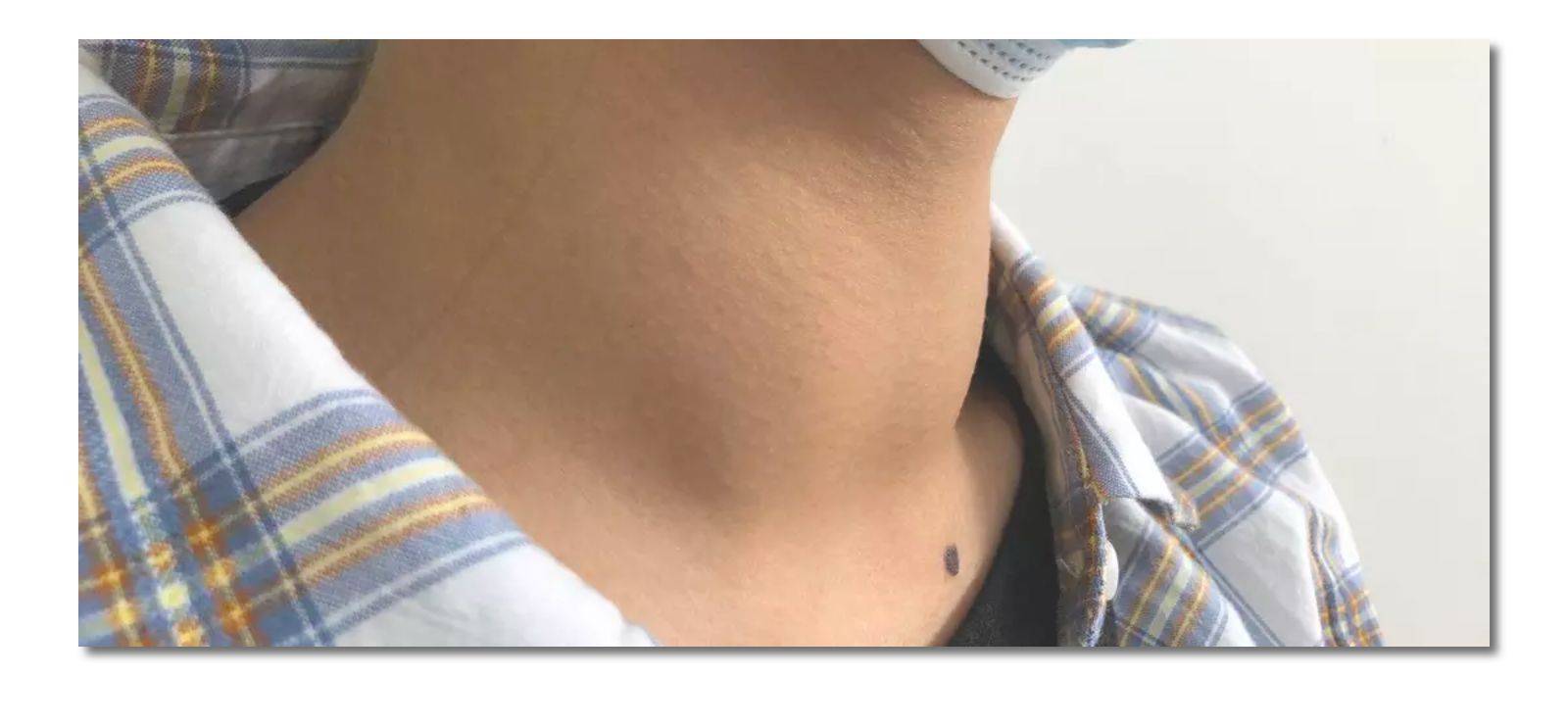 甲状腺结节脖子照片图片