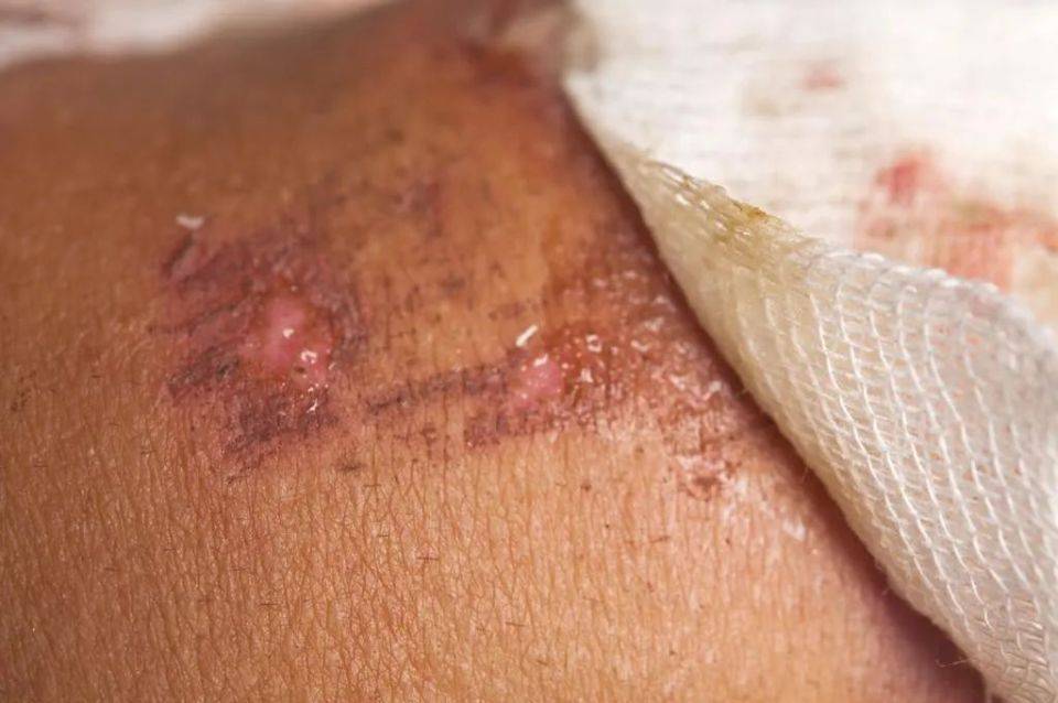 伤口渗液的管理,青岛中腾生物带你了解_敷料_组织_因素