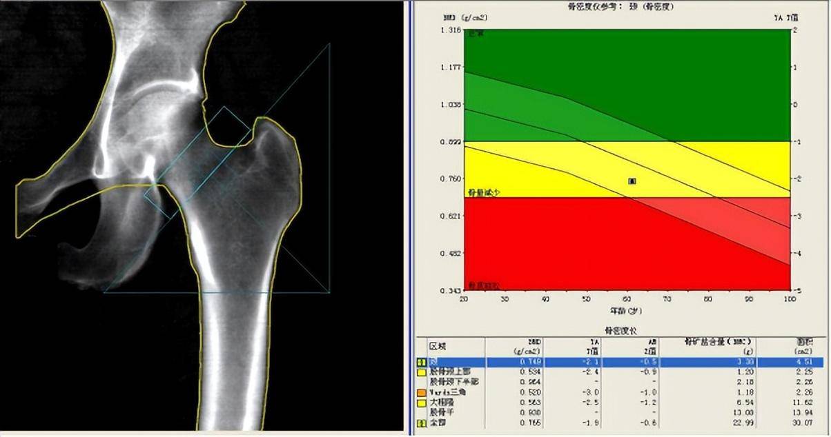 否认有脆性骨折史,双能x线吸收法(dxa)骨密度测定示低骨量(其中股骨颈