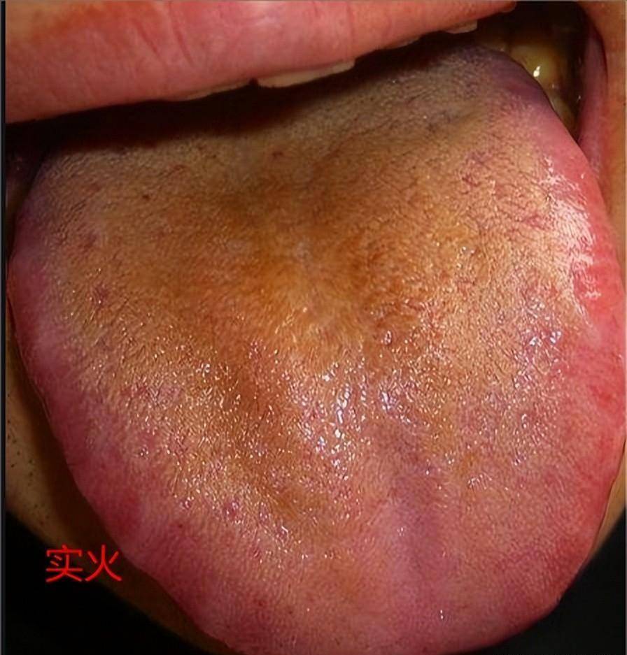 舌头红,厚,凹,凸都是病!