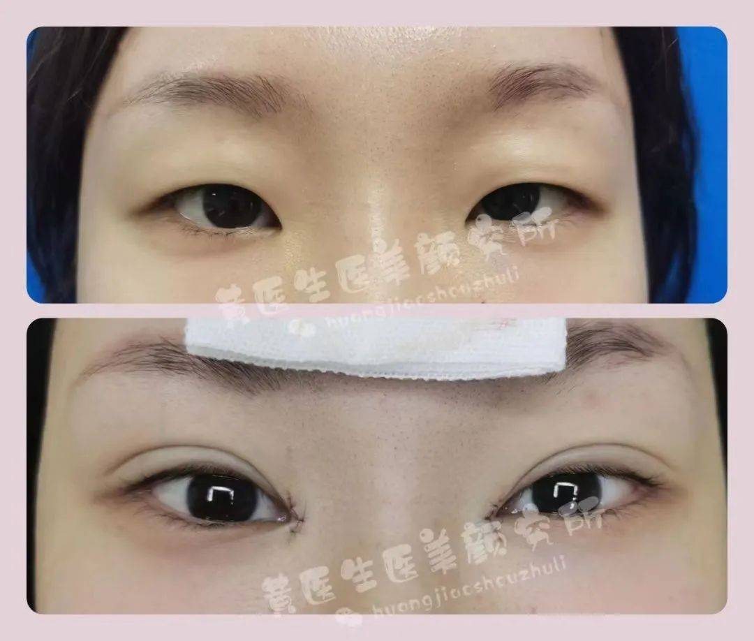 微创短切口双眼皮(102)_柳叶眼_对比_调整
