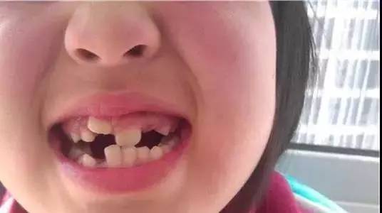 孩子牙缝大是什么原因 怎么修复？