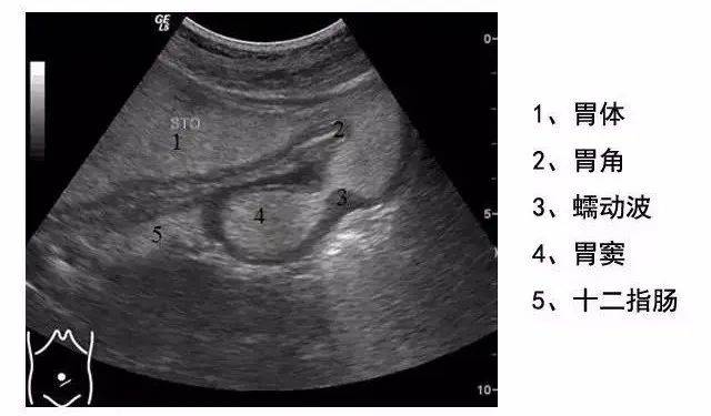 正常胃的超声图像图片