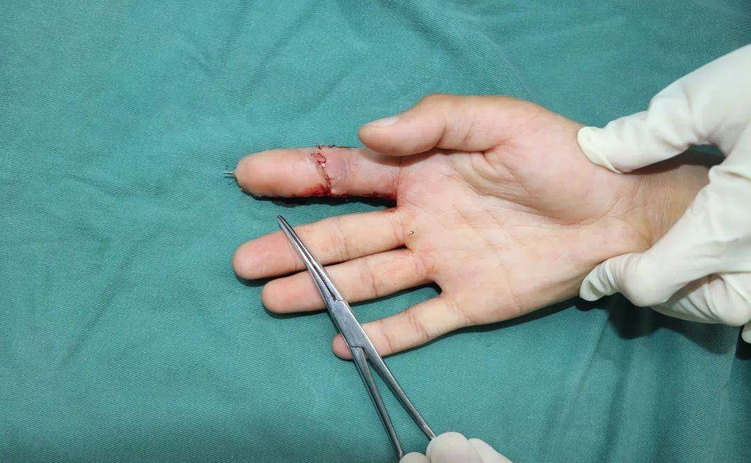 3d全形手指再造术精准再造,原来手指缺损可以这样复原!