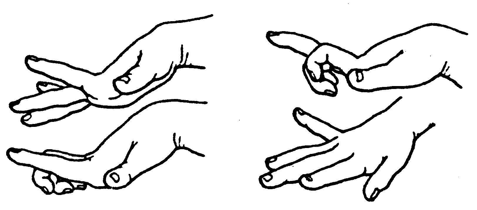 云杉云里医院李博医生:孩子肌张力过高是怎么回事?_宝宝_患者_情况