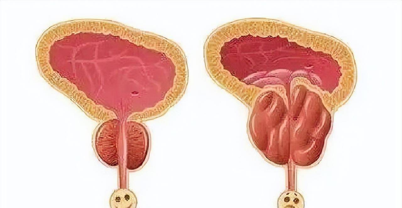 老年人夜尿几次算正常,有哪些危害,如何应对?