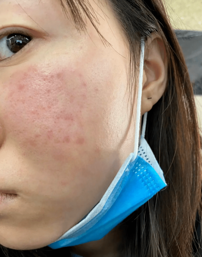 我不允许还有人不知道这个去脂溢性皮炎的方法!_step_严重_结果