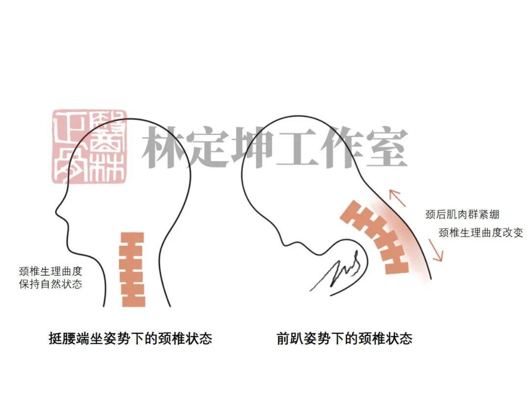 头部前屈图片图片