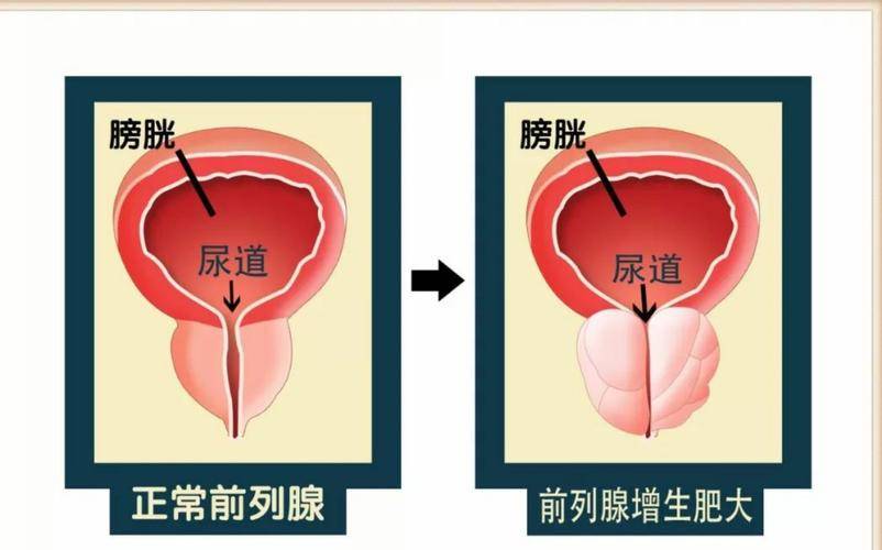 前列腺炎位置 男生图片