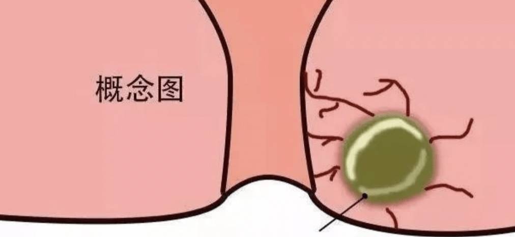 肛门长痘,竟能让猛男频频落泪,肛门脓肿到底是什么病?