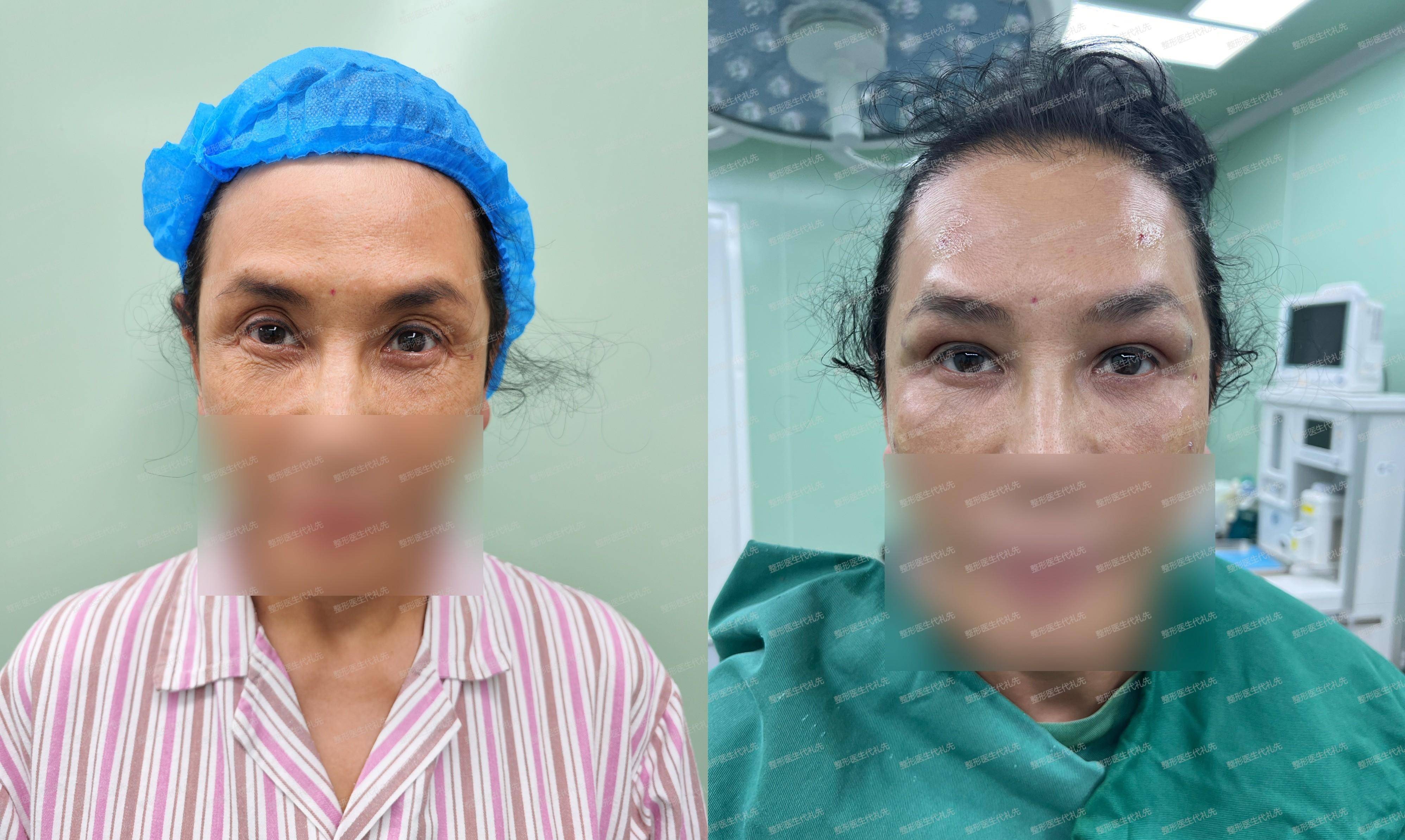 54岁女士做了眼窝凹陷填充术前术后对比,眼睛有这几个变化
