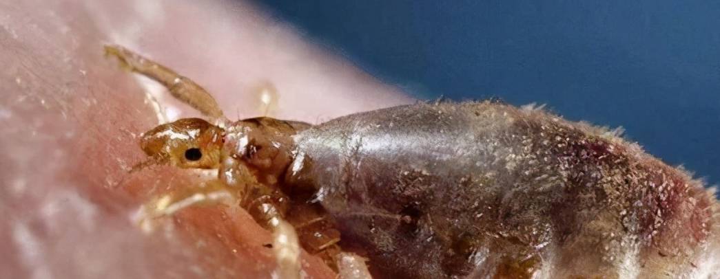 上世纪六七十年代,人的身上为什么有虱子?现在却消失不见了?