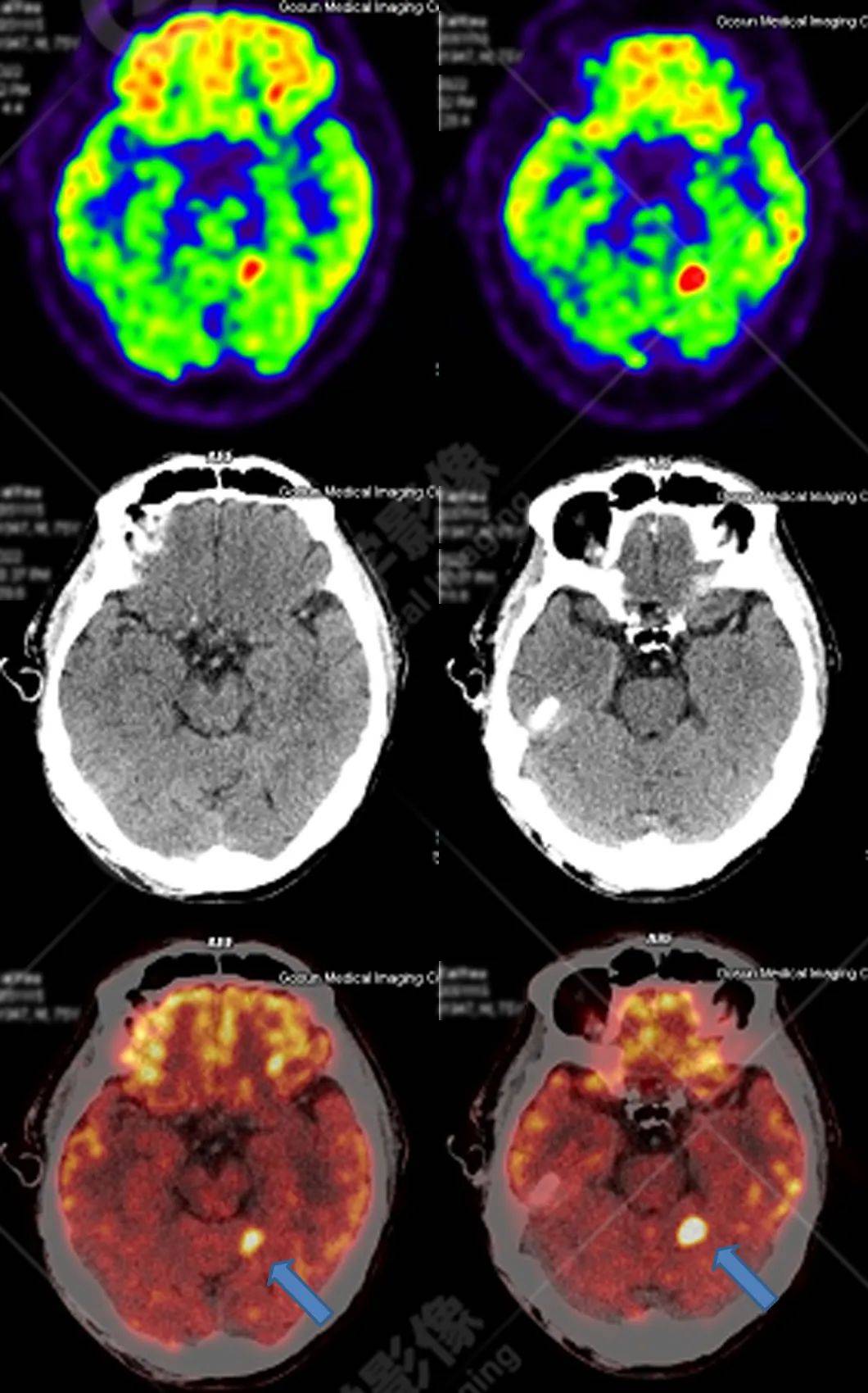 【预防肿瘤】来谈谈肿瘤诊疗中的pet/ct_诊断_检查_淋巴结