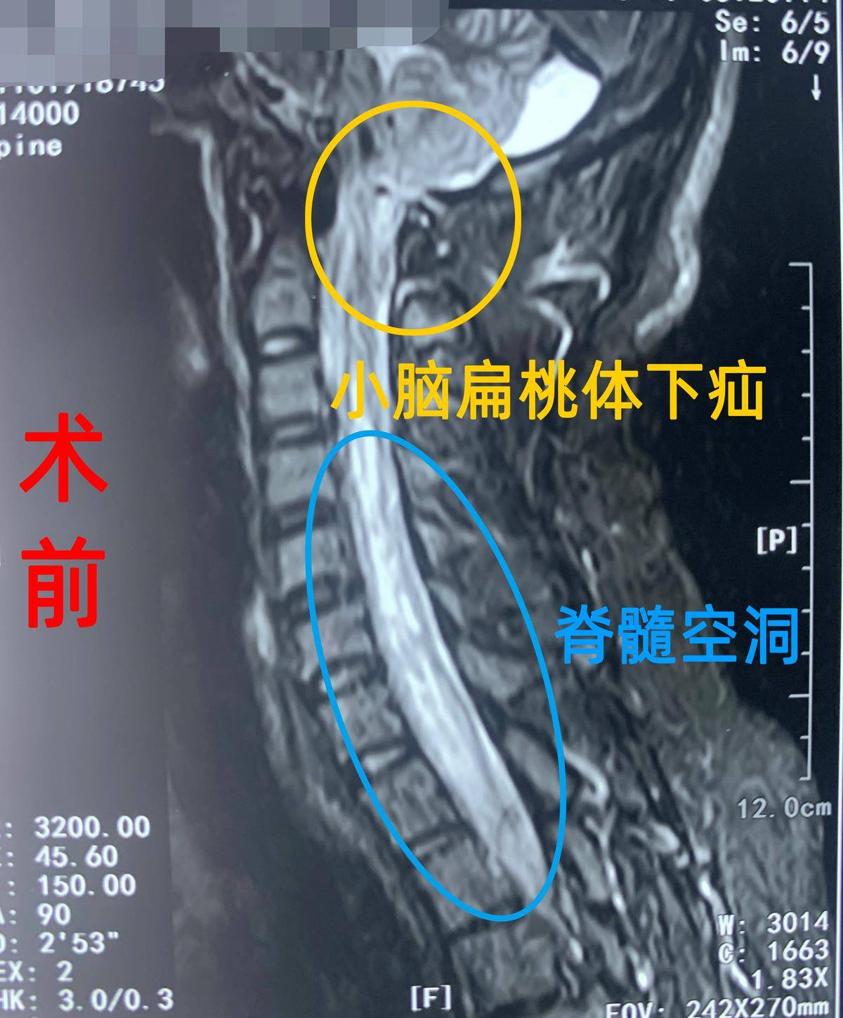 这种情况,王作伟主任建议手术治疗,尽快解决小脑扁桃体下疝问题,防止