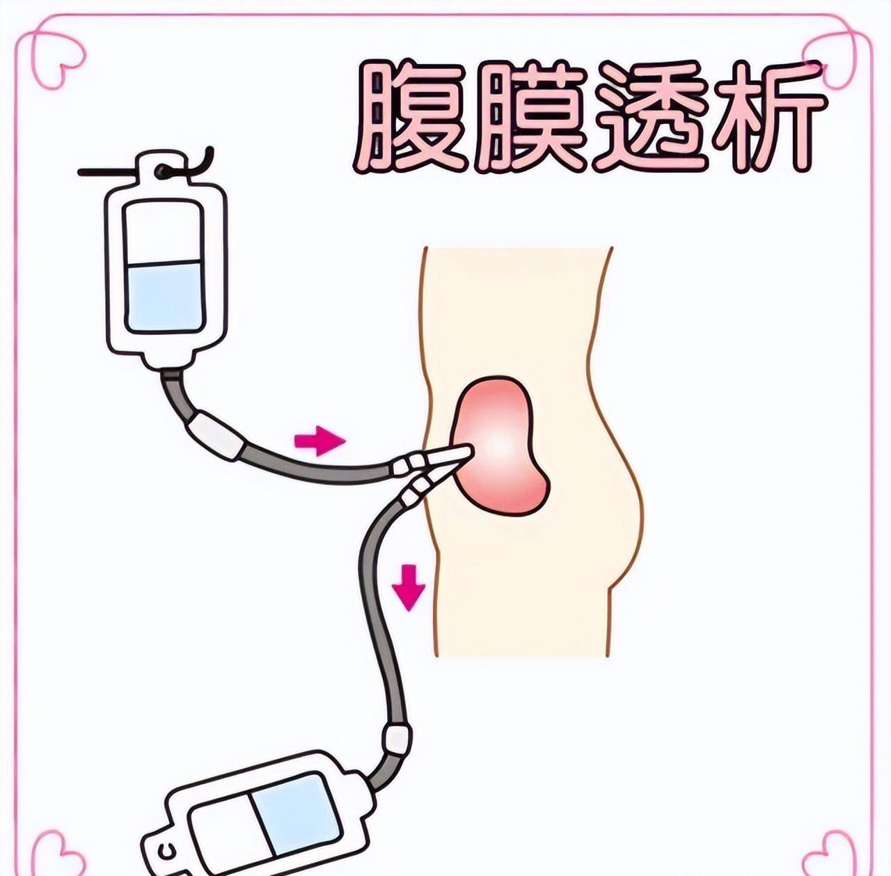 腹膜透析卡通图片