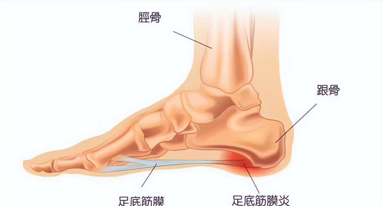 可能與這3個因素有關,若你有,請多加註意_患者_原因_韌帶