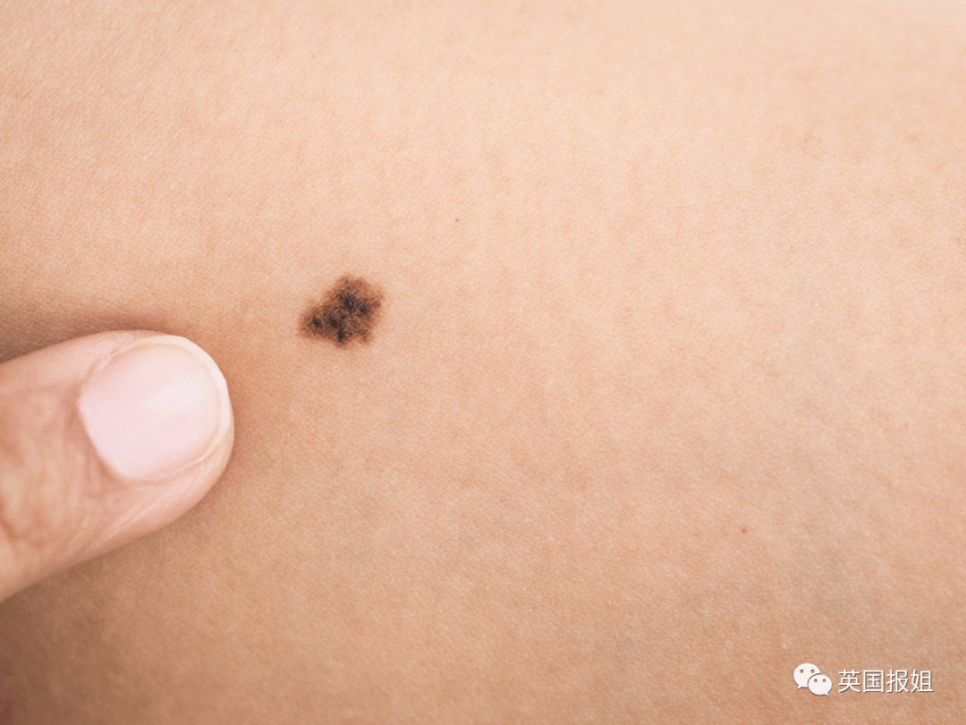 然而,黑色素瘤通常具有以下特征:1.形状不规则,比如非常不对称的痣2.