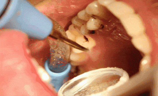 龋齿坏几颗牙，但牙周炎可能会毁掉一口牙！