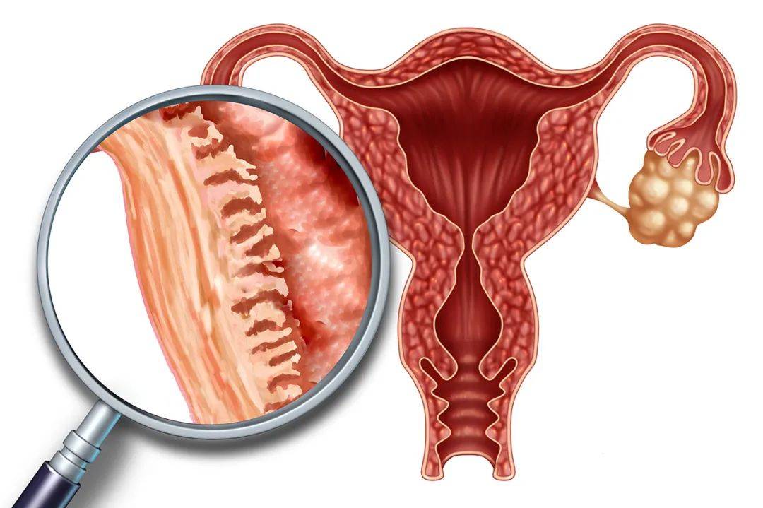 备孕一直没成功?你可能是子宫内膜没调理到位_影响_治疗_厚度