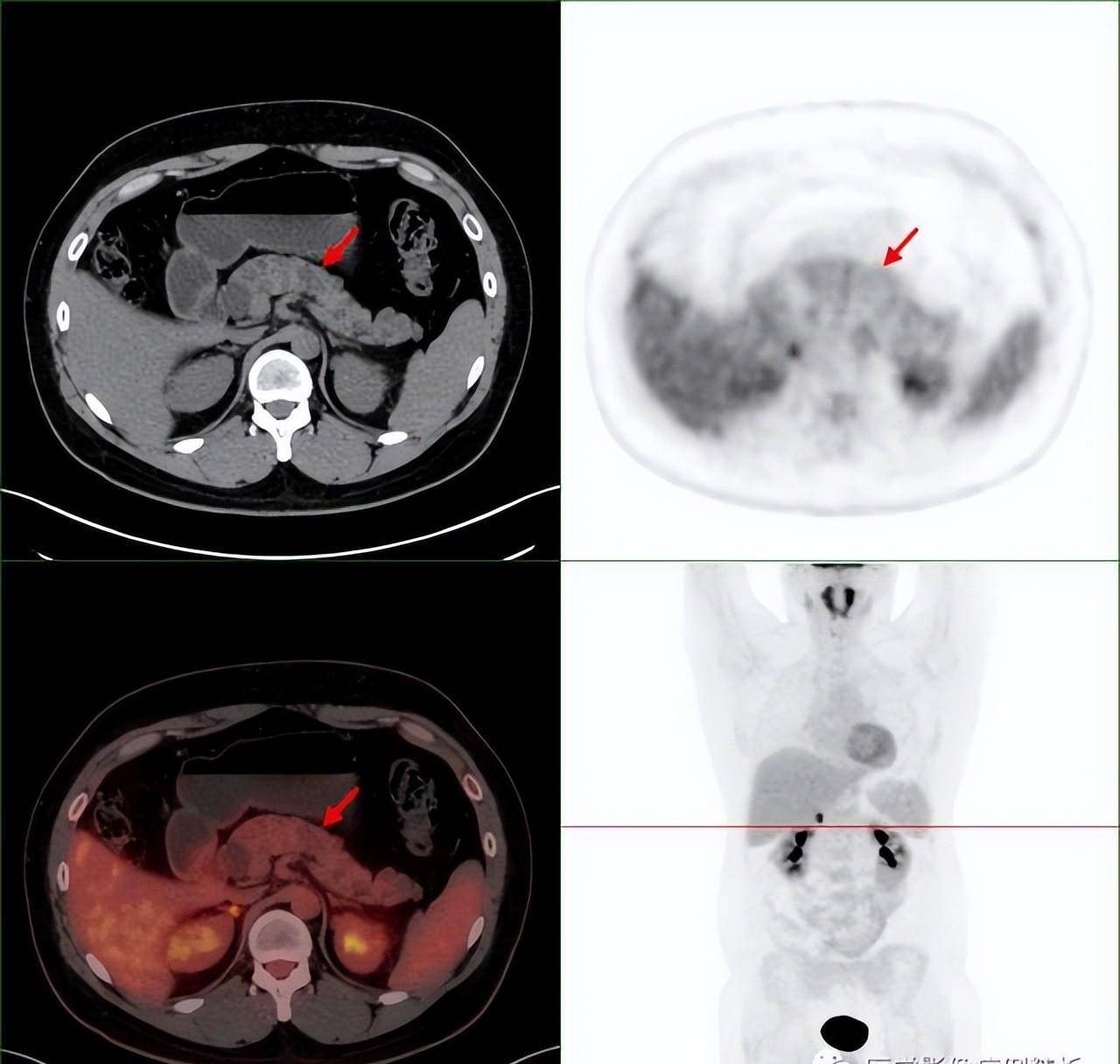单纯肾病吗?vhl综合征(林岛综合征)pet-ct影像诊断及鉴别诊断
